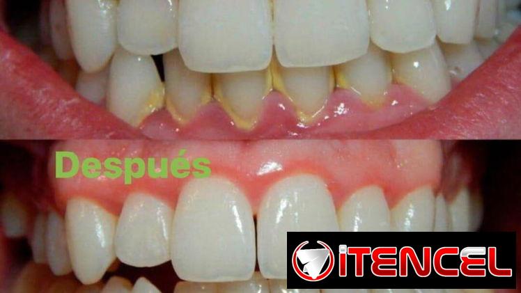 Limpieza dental