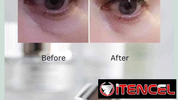 Ojeras / Contorno de Ojos