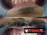 Blanqueamiento Dental Profesional
