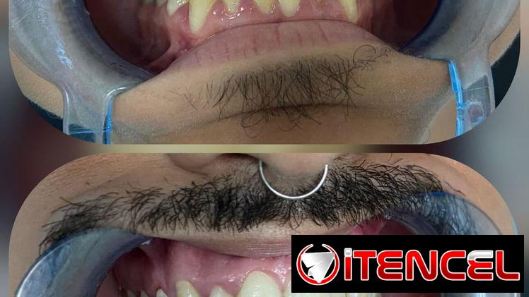 Blanqueamiento Dental Profesional