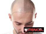 Micropigmentación
