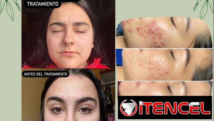 ¡Bálsamo Tea Tree de Dr. C. Tuna by Farmasi! 🌿✨