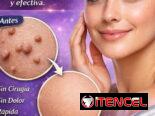 Eliminación de verrugas y Microneedling en la comodidad de su hogar