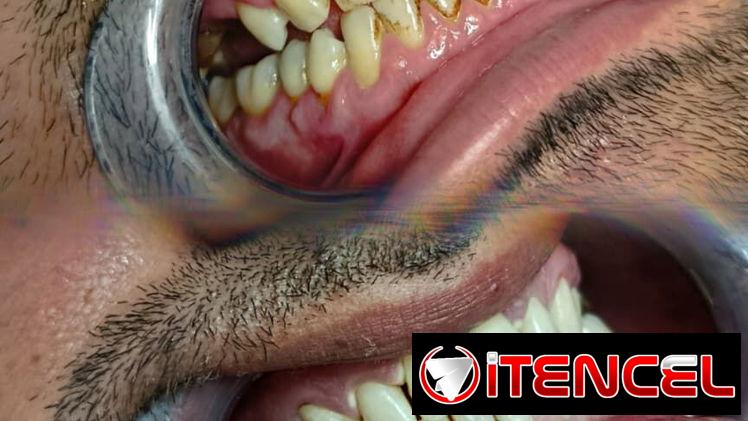Limpiezas y Blanqueamientos Dentales