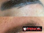 Eliminación de tatuaje con el láser Neatcell 🌟