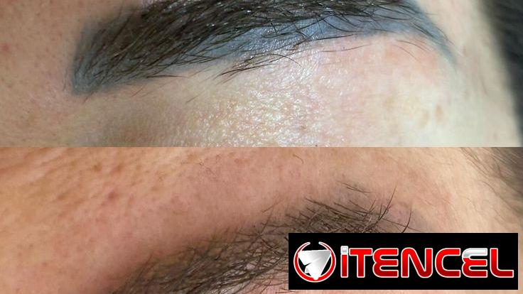 Eliminación de tatuaje con el láser Neatcell 🌟