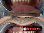 Blanqueamiento Dental Profesional