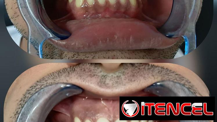 Blanqueamiento Dental Profesional