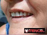 Prótesis Dental Acrílica Removible (Parcial y Total)