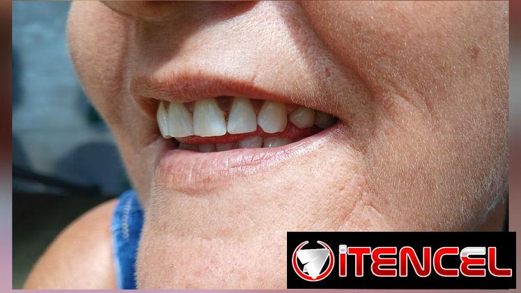 Prótesis Dental Acrílica Removible (Parcial y Total)