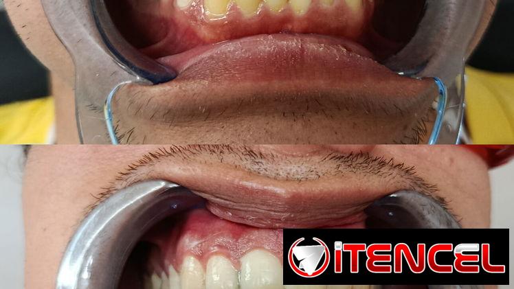 Blanqueamiento Dental Profesional
