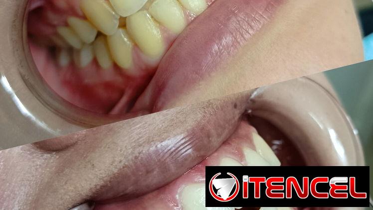 Blanquemientos Dentales