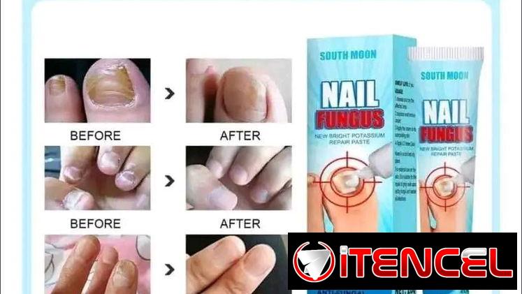 CREMA PREVENTIVA PARA  UÑAS CON ONICOMICOSIS 1900$
