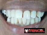 Prótesis Dental Acrílica Removible (Parcial y Total)