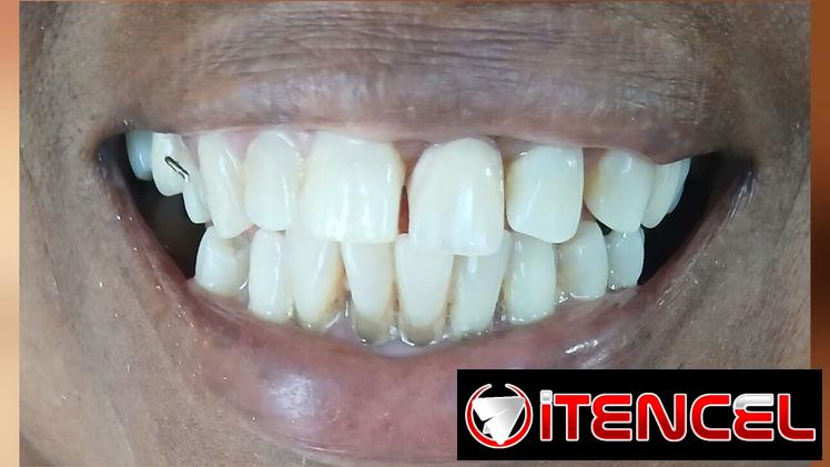 Prótesis Dental Acrílica Removible (Parcial y Total)