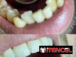 Limpiezas y blanqueamientos dentales
