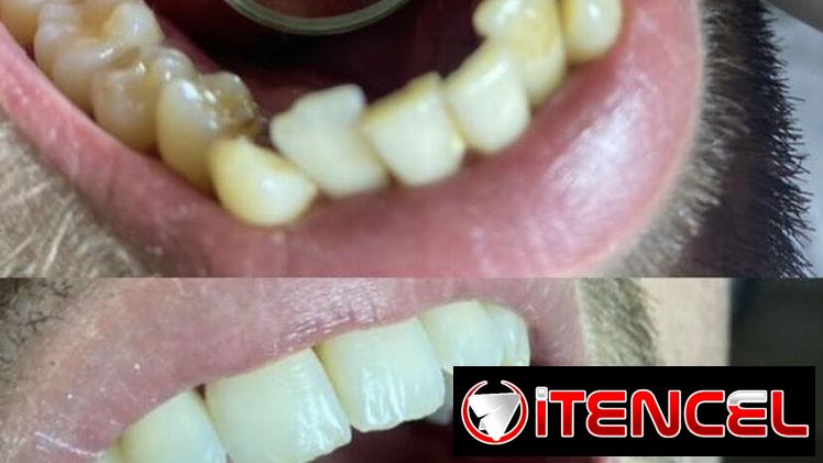 Limpiezas y blanqueamientos dentales