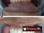 Blanqueamiento Dental Profesional