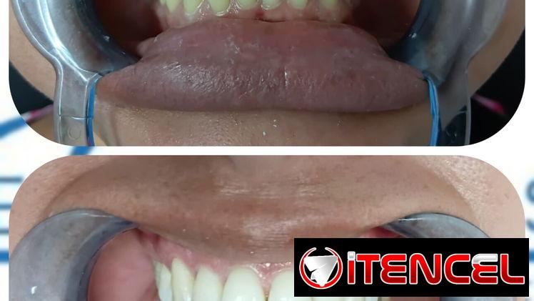 Blanqueamiento Dental Profesional