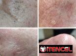 🌿Limpieza facial profunda 🌿 Limpieza profunda de espalda 🌿 Dermapen / Microneedling 🌿 Hidralips Gloss