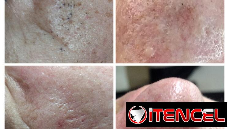 🌿Limpieza facial profunda 🌿 Limpieza profunda de espalda 🌿 Dermapen / Microneedling 🌿 Hidralips Gloss