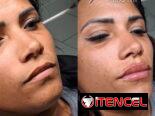 💉 Descubre el poder de la técnica de 4 puntos con ácido hialurónico y el aumento de labios en Spa Leydis. Ubicado en Ma