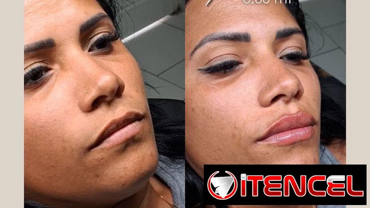 💉 Descubre el poder de la técnica de 4 puntos con ácido hialurónico y el aumento de labios en Spa Leydis. Ubicado en Ma
