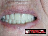 Prótesis Dental parciales y totales removible de acrílico