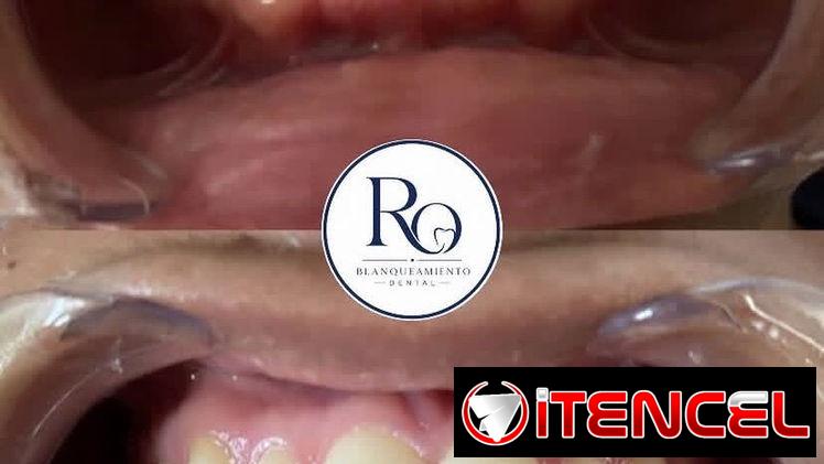 Limpiezas y blanqueamientos dentales