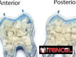 Coronas Dentales