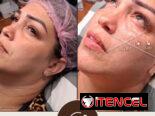 💉 Descubre el poder de la técnica de 4 puntos con ácido hialurónico y el aumento de labios en Spa Leydis. Ubicado en Ma