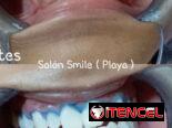 Blanqueamiento y limpieza dental