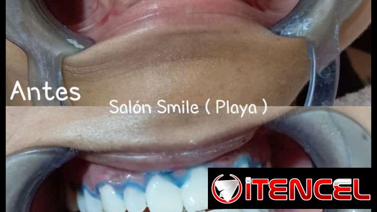 Blanqueamiento y limpieza dental