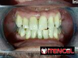 Blanqueamiento Dental Profesional
