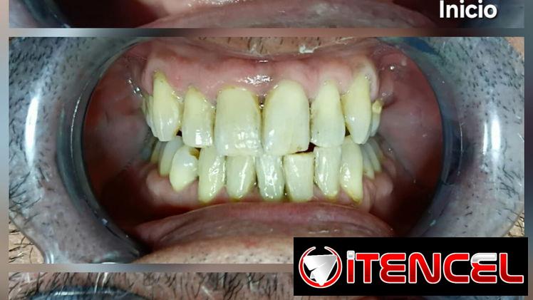Blanqueamiento Dental Profesional