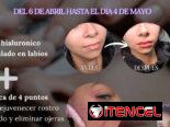 💉 Descubre el poder de la técnica de 4 puntos con ácido hialurónico y el aumento de labios en Spa Leydis Marianao 🌸