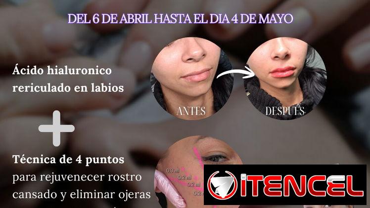 💉 Descubre el poder de la técnica de 4 puntos con ácido hialurónico y el aumento de labios en Spa Leydis Marianao 🌸
