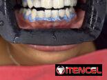 Blanqueamiento y limpieza dental