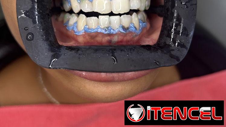 Blanqueamiento y limpieza dental