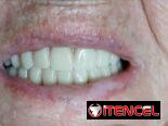 Prótesis Dental Acrílica Removible (Parcial y Total)