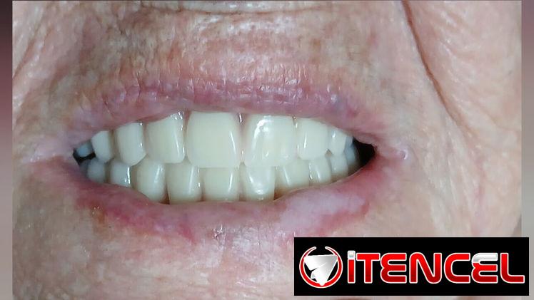 Prótesis Dental Acrílica Removible (Parcial y Total)