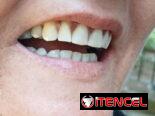 Prótesis Dental parciales y totales removible de acrílico