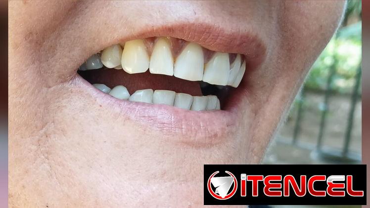 Prótesis Dental parciales y totales removible de acrílico