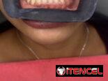 Blanqueamiento y limpieza dental
