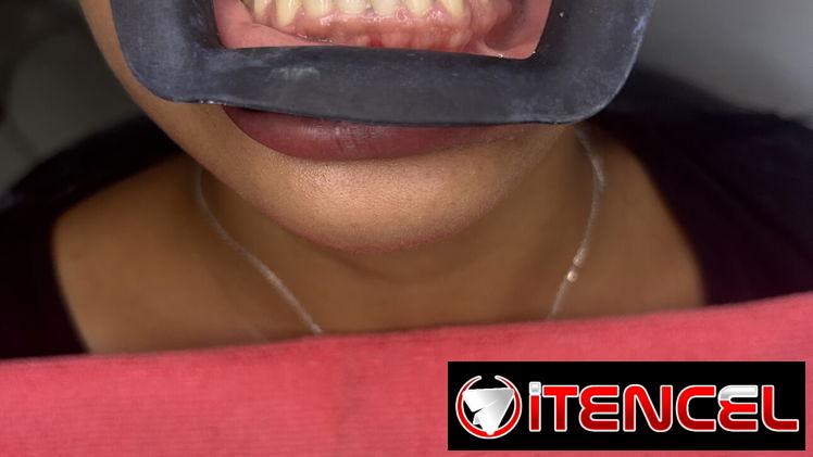 Blanqueamiento y limpieza dental