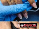 Eliminación de tatuaje con el láser Neatcell 🌟