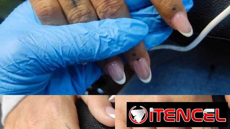 Eliminación de tatuaje con el láser Neatcell 🌟