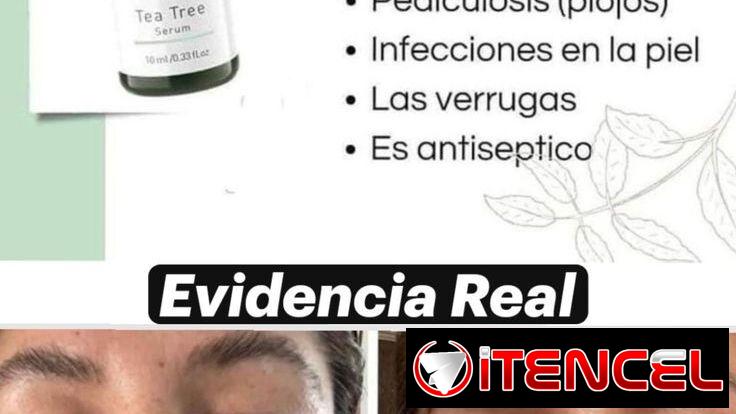 Sérum de Tea Tree para el acné, resequedad y caspa, elimina los hongos  ayuda a eliminar verrugas