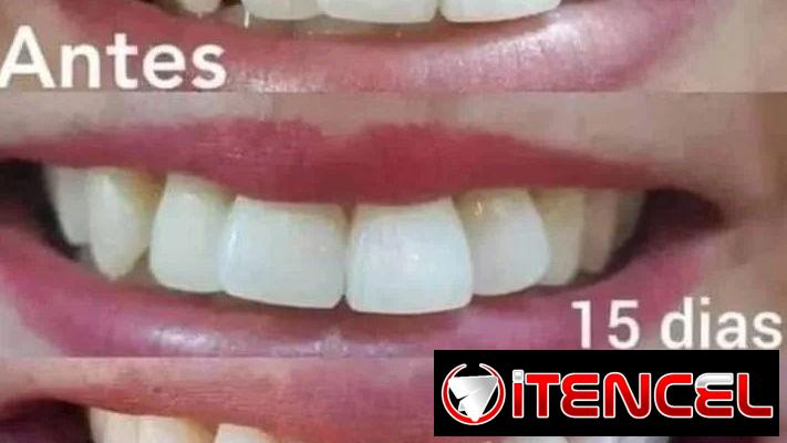 ¿Deseas una sonrisa brillante?