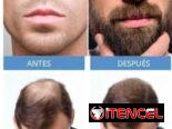 Minoxidil: Tratamiento para el crecimiento del cabello.